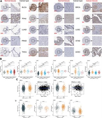 Pan-Cancer Analysis, Reveals COVID-19-Related BSG as a Novel Marker for Treatment and Identification of Multiple Human Cancers